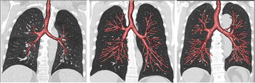Lungs